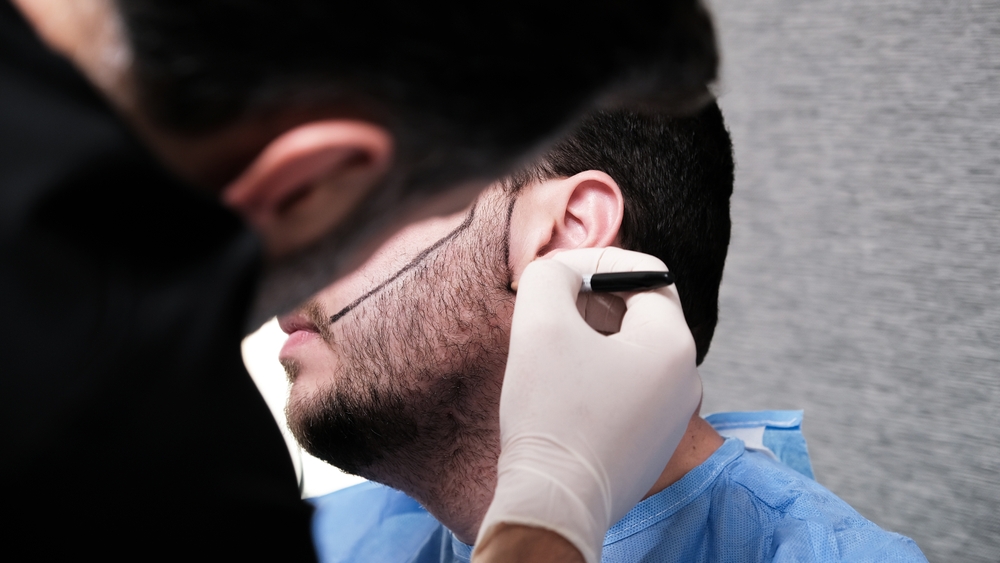 Beard & Mustache Transplant