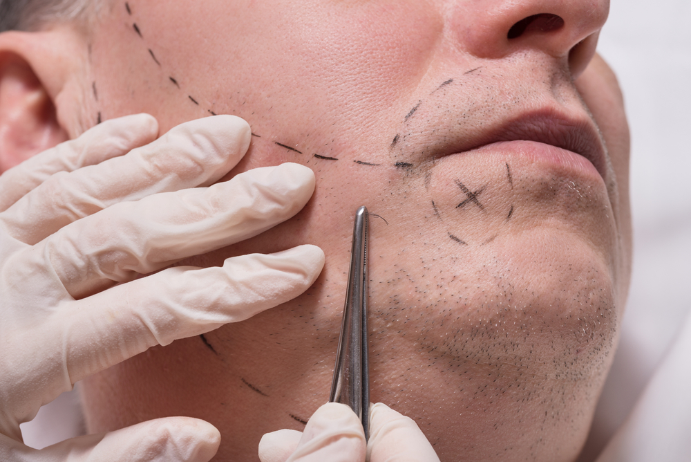 Beard & Mustache Transplant