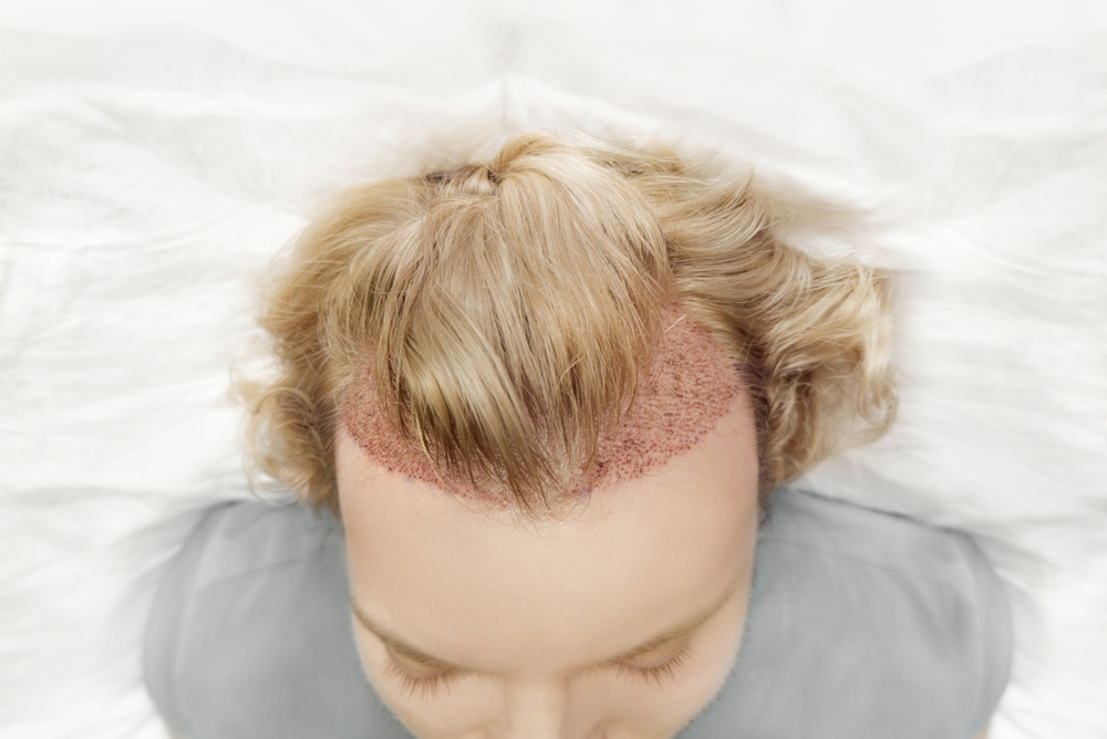 Unshaven Hair Transplant