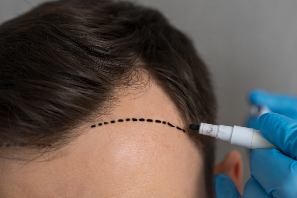 Unshaven Hair Transplant