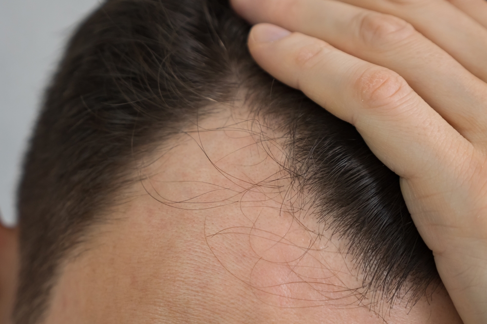 Unshaven Hair Transplant