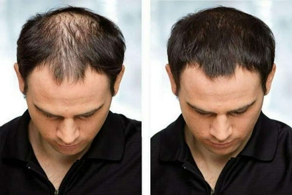 When Can You Expect to See New Hair Growth After a Hair Transplant?